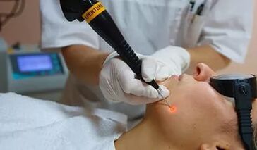 Účinný postup pro odstranění papilomu na obličeji laserem