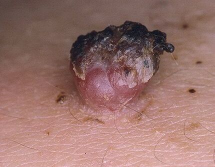 zčernalé papilloma