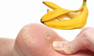 Banánová kůra pro léčbu plantárního bradavice