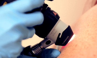 Diagnostické metody pro plantární bradavici