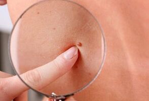 důvody pro výskyt papilomů na lidském těle