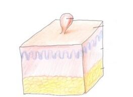 jak se zbavit papilomu na těle