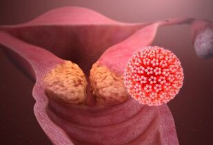 jaké nemoci způsobují HPV